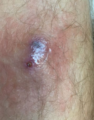 Lesión nodular eritematosa con un orificio donde se observa extremo distal de la larva.