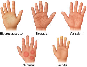 Principales subtipos morfológicos de eccema de manos (hiperqueratósico, vesicular, fisurado, numular y pulpitis). Ilustración elaborada por el autor con asistencia de inteligencia artificial (ChatGPT-5).