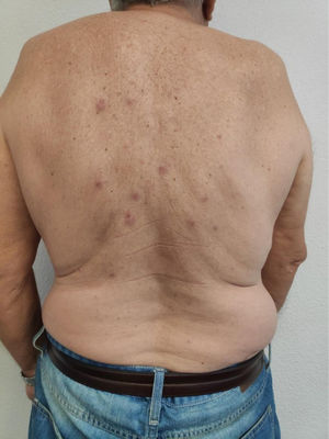 Lesiones eritemato-edematosas en región media e inferior de espalda que presentaba el paciente.
