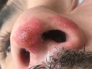 Dermatitis nasal irritativa tras inhalación recreativa de poppers. Vista basal: la misma lesión se aprecia con mayor intensidad eritematosa, descamación blanquecina perifolicular y discreto exudado seroso en el borde inferior del ala nasal. No hay afectación de la mucosa vestibular ni de estructuras cartilaginosas subyacentes.