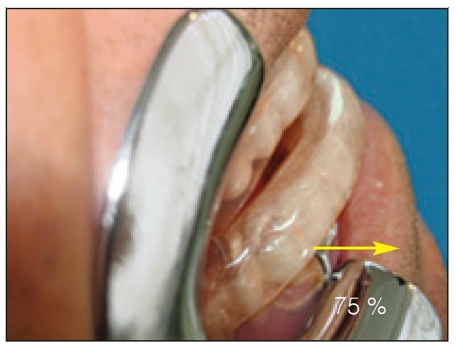 Férula de avance mandibular - Centre Odontològic els Quinze