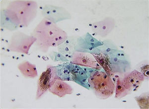 Frotis normal en paciente no fumadora Microfotografías tomadas con objetivo seco fuerte 40X, microscopio Zeiss e iluminación Kohler