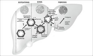 Modelo de la participación de los cristales de colesterol en el desarrollo de EHNA y fibrosis. 1) Cristalización de colesterol en hepatocitos, activación del inflamasoma NLRP3 y producción de quimiocinas y citocinas. 2) Formación de estructuras tipo corona (ETC) a través de la agregación de células de Kupffer (CKs). 3) Transformación de las CKs a células espumosas activadas por acumulación de cristales de colesterol. 4) Activación y transformación de células estelares hepáticas a miofibroblastos productores de colágena. Abreviaturas: IL-1β, interleucina 1 beta; IL18, Interleucina 18; MCP1, proteína quimioatrayente de monocitos 1; TGF-β, factor de crecimiento transformante beta; NLRP3, inflamasoma que contiene los dominios: LRR (rico en repeticiones de leucina), NOD (domino central de unión a nucleótidos NACHT) y un dominio N-terminal PYD (dominios pirina). Basado en 12,130.