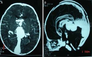 A) and B) Computerized axial brain tomography evidencing important dilation and tortuosity of vein of Galen.