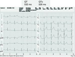 Electrocardiograma de 12 derivaciones de una paciente con SQTL. El intervalo QT mide 532ms y el QTc 526ms. Nótese la morfología en V5 característica del SQTL tipo 1.