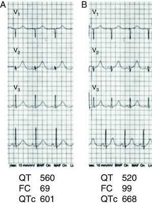 Derivaciones V1 a V3 de un paciente con SQTL. En el trazo basal el QTc es de 601ms, al adoptar el ortostatismo la FC se incrementa a 99 lpm y el QTc a 668ms.