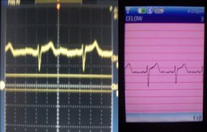 En el lado izquierdo de la figura se observa la señal del ECG, en un osciloscopio colocando los electrodos en DI, de lado derecho se observa la misma señal pero ahora en la pantalla del móvil.