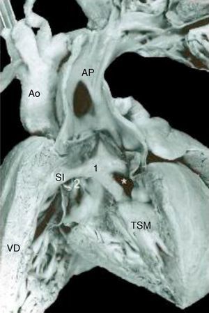 Vista interna del ventrículo derecho y de la arteria pulmonar que muestra las características del complejo de Taussig-Bing. Obsérvese las grandes arterias lado a lado, el doble infundíbulo subpulmonar (1) y el subaórtico (2, sonda) y la comunicación interventricular debajo de la arteria pulmonar (asterisco). SI: septum infundibular; TSM: trabécula septomarginal; Ao: aorta; AP: arteria pulmonar; VD: ventrículo derecho.