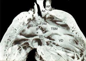 Vista interna del ventrículo derecho con doble salida. Obsérvese la aorta anterior derecha, la arteria pulmonar posterior izquierda, los infundíbulos subaórtico amplio y subpulmonar estenótico, el pliegue infundíbulo ventricular (asterisco negro) y la comunicación interventricular (asterisco blanco). VD: ventrículo derecho; SI: septum infundibular; TSM: trabécula septomarginal; Ao: aorta; AP: arteria pulmonar; VT: válvula tricúspide; IP: infundíbulo subpulmonar; IAo: infundíbulo subaórtico.
