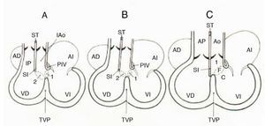 Esquemas que muestran el proceso de conexión ventriculoarterial en el corazón normal según los horizontes de Streeter. A) Horizonte XIV que muestra la doble salida del ventrículo derecho. B) Horizonte XVII. Obsérvese el cabalgamiento aórtico. C) Horizonte XIX que muestra la conexión ventriculoarterial concordante. C: cameral; 2: comunicación interventricular secundaria; 1: formaen bulboventricular primario; F: foraminal; I: infundibular; ST: septum troncal; TVP: tabique ventricular primitivo; VD: ventrículo derecho; VI: ventrículo izquierdo; AD: aurícula derecha; AI: aurícula izquierda; SI: septum infundibular; Ao: aorta; AP: arteria pulmonar; IP: infundíbulo pulmonar.