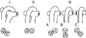Esquemas que muestran la clasificación de la doble salida de ventrículo derecho según la relación entre las grandes arterias: I, ligeramente entrecruzadas; II, paralelas en el plano frontal (lado a lado); III, paralelas en el plano posterior. A: aorta anterior; B: aorta anterior; C: aorta anterior izquierda.