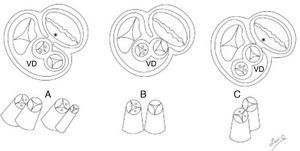 Esquemas de cortes transversales de la base del corazón (superiores) y las posiciones de las vías de salida (inferiores). A) Salidas anteroposteriores (complejos de Eisenmenger y Fallot), B) salidas lado a lado (complejo de Taussig-Bing), C) salidas anteroposteriores con aorta anterior. *Discontinuidad atrioventricular sigmoidea. VD: ventrículo derecho.