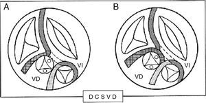 A) Esquemas que muestran un solo infundíbulo y, B) 2 infundíbulos en la doble cámara de salida de ventrículo derecho (DCSVD). VD: ventrículo derecho; VI: ventrículo izquierdo.