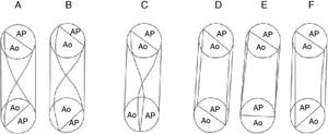 Esquemas que muestran diferentes grados de torsión del tabique troncoconal en la doble salida de ventrículo derecho: A) 135° (complejo de Eisenmenger); B) 135° (tetralogía de Fallot); C) 90° (complejo de Taussig-Bing); D) 0° (aorta anterior derecha); E) −45° (aorta anterior); F) −90° (aorta anterior izquierda). Ao: aorta; AP: arteria pulmonar.
