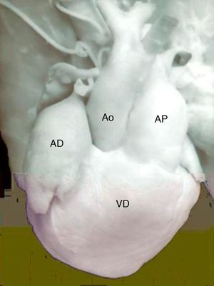 Vista externa de un corazón con doble salida de ventrículo derecho con arterias ligeramente entrecruzadas (complejo de Eisenmenger). Obsérvese la dextroposición de la aorta y la dilatación del tronco de la arteria pulmonar. AD: aurícula derecha; Ao: aorta; AP: arteria pulmonar; VD: ventrículo derecho.