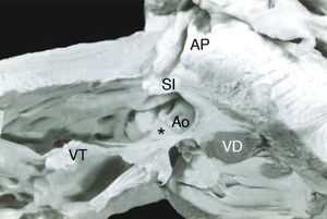 Vista interna de un corazón con doble salida de ventrículo derecho y tetralogía de Fallot. Obsérvese el nacimiento de la aorta en más del 50% a partir del ventrículo derecho, el desplazamiento anterior del septum infundibular, la estenosis pulmonar y la hipertrofia del ventrículo derecho. *Pliegue infundíbulo ventricular. Ao: aorta; AP: arteria pulmonar; VD: ventrículo derecho; VT: válvula tricúspide; SI: septum infundibular.
