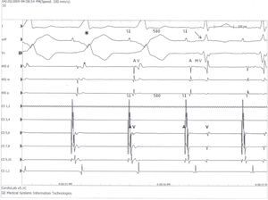 Periodo refractario anterógrada largo. Estimulación desde el seno coronario distal a un ciclo S1S1 de 580ms con preexcitación máxima y bloqueo súbito (flecha) de la conducción anterógrada de la vía accesoria (normalización del QRS), en un paciente caso con WPW asintomático. De arriba abajo derivaciones ECG I, aVF y V1, trazos intracardiacos: Hisd, Hism, Hisp=electrogramas del haz de His distal, medio y proximal; electrogramas del seno coronario distal CS1-2 al proximal CS9-10. AV: intervalo auriculoventricular; AHV: electrogramas auricular, del haz de His y ventricular.