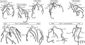 Representación gráfica de los tipos de doble ADA. ADAp: arteria descendente anterior proximal; ADA-C: arteria descendente anterior corta; ADA-L: arteria descendente anterior larga; CD: coronaria derecha; Cx: circunfleja; DG: diagonal; OAD: oblicua anterior derecha; OAI: oblicua anterior izquierda; S: septales; TCI: tronco coronario izquierdo; VD: ventrículo derecho; VI: ventrículo izquierdo. Modificada de Spindola-Franco H et al.3.