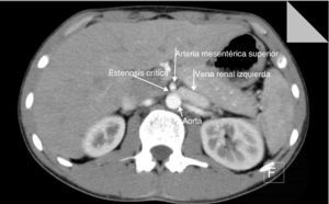 Corte axial de tomografía computada con contraste endovenoso en fase arterial, donde se demuestra la compresión de la vena renal izquierda entre la aorta y la emergencia de la arteria mesentérica superior con dilatación retrógrada.