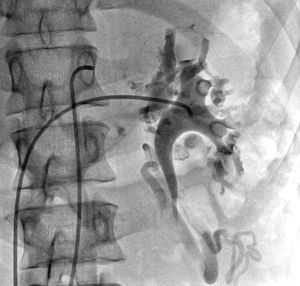 Flebografía selectiva de la vena renal izquierda en proyección posteroanterior, que muestra congestión venosa con importantes vasos colaterales y dilatados.
