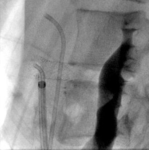 Proyección lateral, que muestra el resultado final del stent autoexpandible con adecuada apertura del mismo.