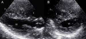 Ecocardiograma transtorácico bidimensional en los planos eje largo (A) y eje corto (B) paraesternal, que muestra 2 cámaras del ventrículo derecho: proximal (1) y distal (2). AI: aurícula izquierda; Ao: aorta; VI: ventrículo izquierdo.