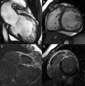 Cardiac-MRI: SSFP sequence and LGH sequence. Dilated left ventricle with non-compaction criteria and late gadolinium hyperenhancement reflecting fibrosis. (C and D) Ejection fraction was 30%.6