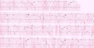 ECG que muestra ciclos corto-largo-corto con taquicardia ventricular polimórfica de tipo taquicardia helicoidal.
