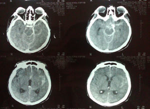 Tomografía axial de cerebro: hemorragia subaracnoidea Fisher III en área silviana izquierda.