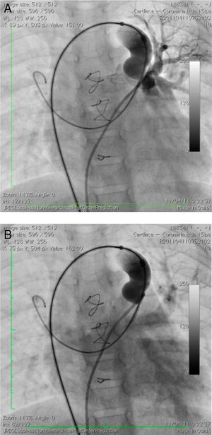 A) Inyección selectiva del medio de contraste en la rama izquierda de la arteria pulmonar. B) Se observa en la levofase el retorno venoso a la aurícula izquierda.