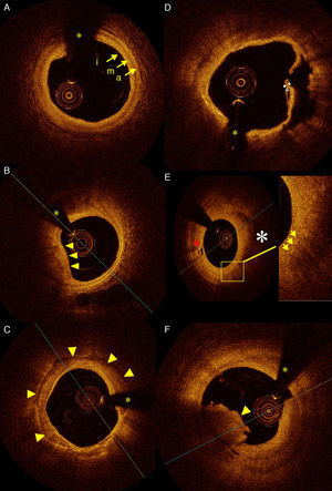 A) Imagen de TCO intracoronaria que muestra un segmento de arteria coronaria donde se pueden determinar con claridad las 3 capas vasculares: intima (i), media (m) y adventicia (a). B) Placa lipídica (flechas) con bordes difusos y mal definidos. C) Arteria coronaria derecha con gran placa de calcio (flechas) con bordes nítidos. (*) Sombra de la guía intracoronaria. D) Placa rota en un paciente con síndrome coronario agudo con elevación del segmento ST; se observa la placa rota (grosor de 13μm) y la úlcera después de vaciar su contenido lipídico. E) Placa lipídica (*) que se aprecia con bordes mal definidos. La flecha roja muestra los vasos vasorum. La placa lipídica muestra pequeños puntos (flechas amarillas) con ausencia de señal posterior, que dejan sombra y que pueden corresponder al alto contenido de células inflamatorias (macrófagos) en la placa lipídica. F) Estructura de bordes irregulares que protruye en la luz y con sombra posterior correspondiente a trombo intracoronario (flecha).