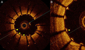A) Imagen de TCO que muestra arteria coronaria derecha posterior a la implantación de un stent. Se puede observar la adecuada aposición de los soportes (struts) del stent (flechas amarillas) sobre la pared del vaso. B) Imagen con aumento.