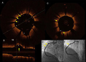 Hombre de 45 años, dislipidémico y fumador, con un infarto de miocardio con elevación del segmento ST de localización inferior. A) Imagen de TCO en la que se muestran los soportes (struts) del stent implantado (flechas) con una clara zona de malaposición debido a ectasia de la coronaria derecha (*). B) Imagen de TCO, en un eje longitudinal, que muestra la zona de malaposición (flecha) y la zona aneurismática (*). C) Imagen de TCO que muestra el resultado final posterior a posdilatación con balón del stent en la CD. D) Imagen angiográfica en donde se muestran (flechas) las zonas de ectasia y estenosis severa, responsables del síndrome coronario agudo. E) Resultado angiográfico final.