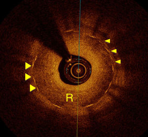 Arteria descendente anterior, en la que se pueden identificar los soportes (struts) del stent implantado 12 meses antes (flechas), y tejido de neoformación intimal que causa restenosis intra-stent (R) severa.