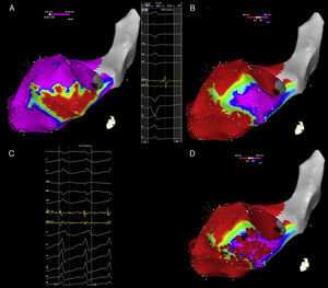 Electroanatomical mapping of the left ventricle with CARTO system and ablation of ventricular tachycardia with activation mapping and late potentials abolition, in a patient with a previous inferior myocardial infarction. (A) Bipolar electroanatomical mapping. The map shows the presence of a large scar area (colour coded in red) in the basal and mid segments of the inferior wall. Settings for scar and border zone identification were <0.5mV and 0.5–1.5mV, respectively. (B) Late potentials map. The left part of the panel shows a late potential recorded far after the end of the surface QRS. The right part of the panel shows the distribution of late potentials in sinus rhythm. The lower cut-off for the activation map was set at the end of the surface QRS complex (51ms); the upper cut-off was set at the timing of the latest late potential recorded (91ms). Areas without late potentials occurring after the end of surface QRS are colour coded in red; the area with late potentials is coded in a gradient of colours ranging from yellow (early after the end of surface QRS) to pink (latest potentials recorded). (C) Activation mapping. The clinical ventricular tachycardia was induced by programmed ventricular stimulation. The distal electrode of the ablation catheter recorded a continuous diastolic activity preceding the surface ventricular tachycardia QRS complex by >70ms. (D) Radiofrequency ablation. Black dots mark the site of successful ablation of the clinical VT, inside the area where late potentials were previously recorded in sinus rhythm. Red dots mark the site of ablation in sinus rhythm, aimed at the complete abolition of late potential activity.