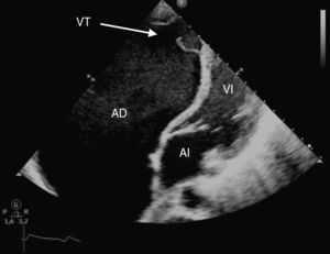 Ecocardiografía, proyección apical-4-cámaras que muestra desplazamiento apical de la válvula tricúspide en relación con anomalía de Ebstein. AD: aurícula derecha; AI: aurícula izquierda; VI: ventrículo izquierdo; VT: válvula tricúspide.