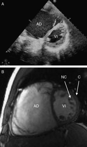 Cortes eje corto en ecocardiograma (A) y cardio-RM (B). AD: aurícula derecha; C: capa compactada; NC: miocardio no compactado; VI: ventrículo izquierdo;.
