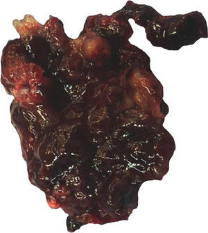 Apariencia macroscópica de un mixoma cardiaco. El tumor es de forma irregular, de aspecto mixoide y hemorrágico. Su dimensión máxima fue de 8.4cm.