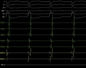 ECG de la paciente con taquicardia supraventricular. Los primeros 6 canales muestran el ECG de superficie; luego los del electrograma (EGM) registrados por el seno coronario (SC) y los del catéter de ablación. Se observa una taquicardia de complejos anchos con morfología de BRIHH. En el SC se observa sobreposición del EGM ventricular y el auricular, sugiriendo una TRNAV. Los EGM obtenido del catéter de ablación muestran VA en el His de 40ms.