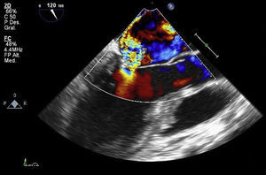 Ecocardiograma transesofágico a nivel medio esofágico en la visión de 3 cámaras, que ilustra la insuficiencia severa excéntrica de la válvula mitral.