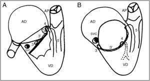 A) El esquema muestra la disposición del sistema de conducción normal y B) la disposición del sistema de conducción en el defecto de la tabicación atrioventricular. 3: nodo atrioventricular; 3′: haz de His; 4: rama izquierda del haz de His; 5: rama derecha del haz de His; AD: aurícula derecha; AP: arteria pulmonar; SVC: seno venoso coronario; VD: ventrículo derecho.