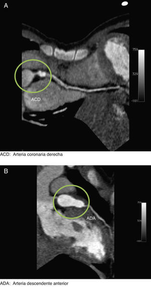 A) Angiotomografía que muestra el aneurisma de la arteria coronaria derecha. B) Angiotomografía que muestra el aneurisma de la arteria descendente anterior. ACD: arteria coronaria derecha; ADA: arteria descendente anterior.