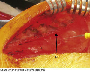 Detalle de la disección de la arteria torácia interna derecha. ATID: arteria torácica interna derecha.