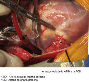 Detalle de la anastomosis de la arteria torácica interna derecha a la arteria coronaria derecha. ACD: arteria coronaria derecha; ATID: arteria torácica interna derecha.