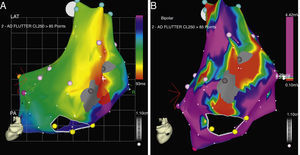 CARTO® map reconstruction of the right atrium in a patient with surgical correction of an ASD: (A) activation map showing a macro-reentrant circuit involving two dense scars in the posterolateral wall. (B) Voltage map showing multiple channels of low voltage arrowed the scars and anatomical barriers.