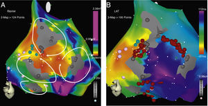 Patient 21: (A) voltage map of the right atrium showing extensive areas of very low voltage forming potential channels around dense scars in the posterior wall. (B) Activation map of the clinical arrhythmia and lines of ablation made to seal all channels.