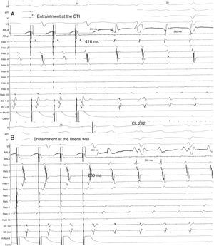 Same patient as Fig. 1. (A) Entrainment mapping is performed first at the cavo-tricuspid isthmus (CTI). Note manifest fusion and a long return cycle (416) in comparison with tachycardia cycle (282). (B) Entrainment mapping at the right lateral wall, between the scars. Observe concealed fusion and a return cycle equal to tachycardia cycle length.