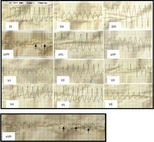 A) ECG de ingreso: taquicardia de QRS ancho regular (>120 mseg), con una FC de 250lpm y eje superior. Las flechas señalan las ondas P disociadas. B) aVR magnificada. Las flechas señalan las ondas P disociadas.