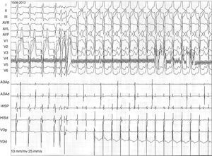 Trazo de estudio electrofisiológico donde se muestra la inducción de taquicardia ventricular monomórfica sostenida con imagen de bloqueo de rama izquierda del haz de His.