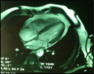 RMN cardíaca con realce tardío que evidencia la pared libre del VD con incremento de su trabeculación, adelgazada y de bordes irregulares, infiltración fibrograsa a nivel basal. No se observa realce tardío de contraste en el resto del miocardio.